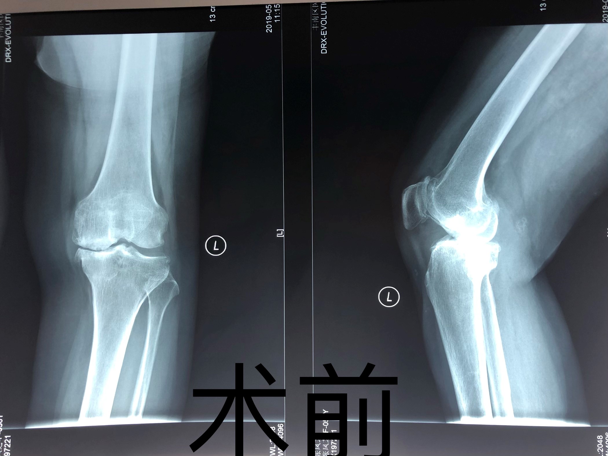 膝关节的结构特点与骨质增生、退型性变。_南通国光中医门诊部