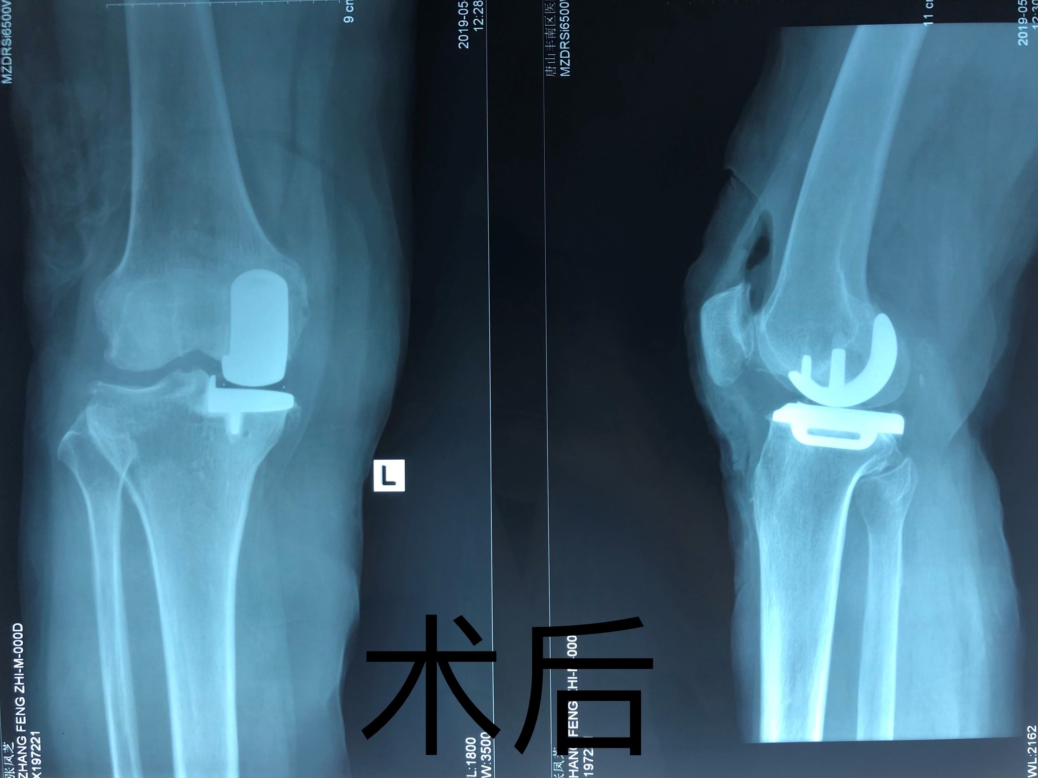 简介膝关节软组织运动损伤类型和案例分析 - 知乎